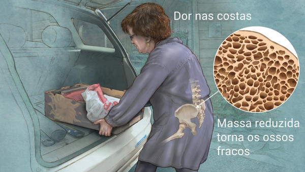 osteoporose tratamento